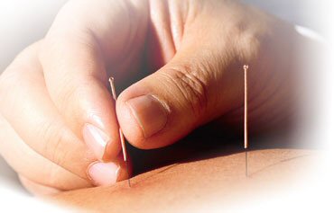 needling